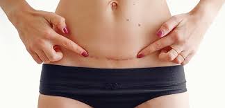 Préparation à la césarienne